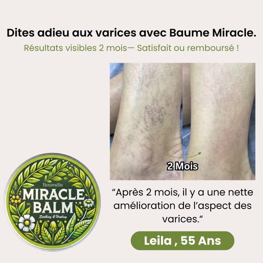 Baumélis™ : Soulagement rapide des varices, en un temps record !
